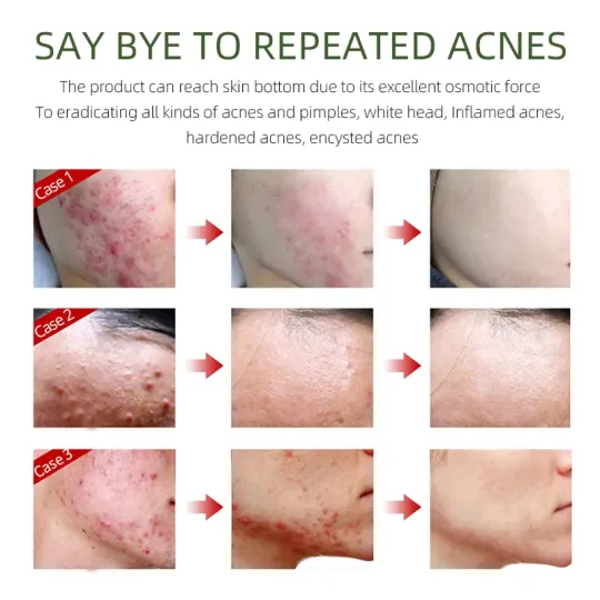 كريم ازالة حب الشباب Joy Pretty Herbal Acne Removing Cream product image