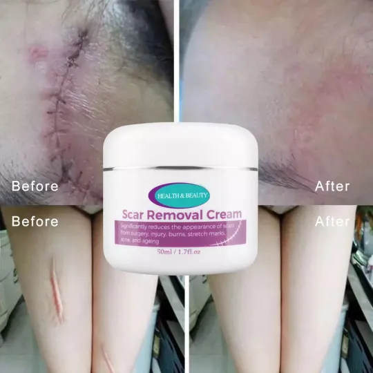 كريم إزالة الندبات Ouhoe Scar Removal Cream product image